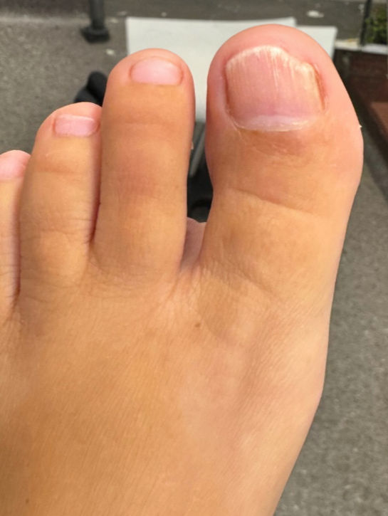 The same toenail showing clear nail growth after laser treatment — Case 2