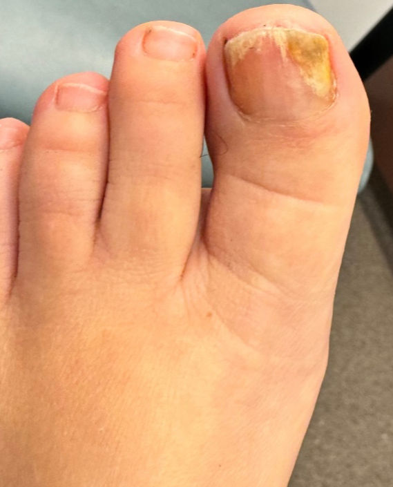 Toenail affected by a fungal infection before laser treatment — Case 2
