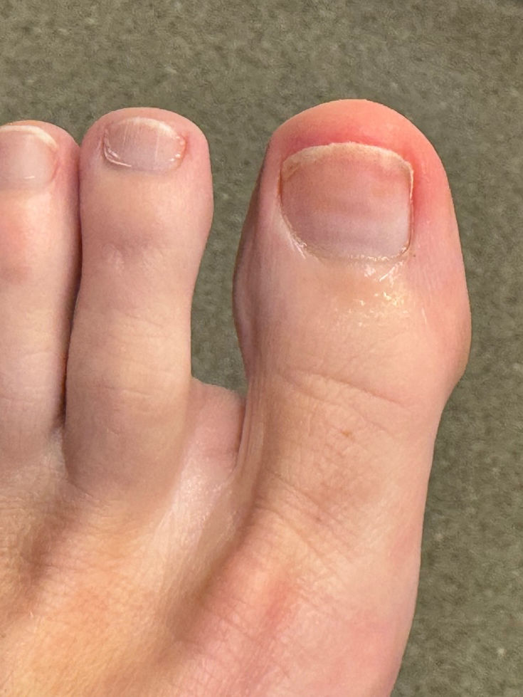 The same toenail showing clear nail growth after laser treatment — Case 3