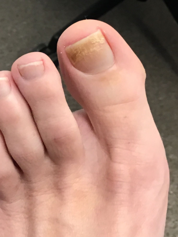 Toenail affected by a fungal infection before laser treatment — Case 3