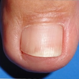 The same toenail showing clear nail growth after laser treatment — Case 1