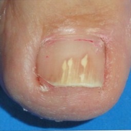Toenail affected by a fungal infection before laser treatment — Case 1